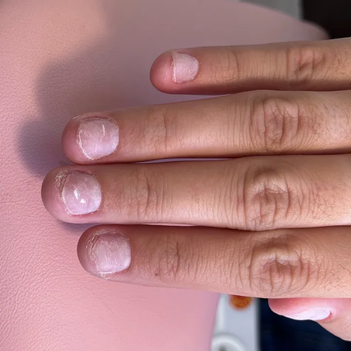 Avant : ongles naturels courts et abîmés